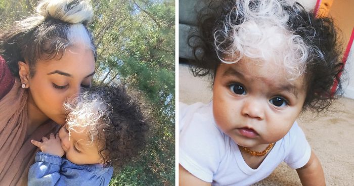 Baby Girl Was Born With An Incredibly Rare Genetic Birthmark, But Wait